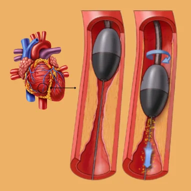 atherectomy surgery in india