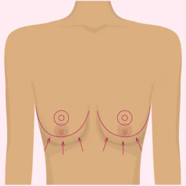 breast reduction surgery