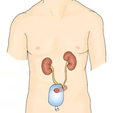 Typhoid