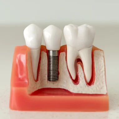 dental implant surgery in india