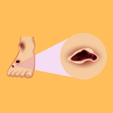 diabetic foot ulcers in india