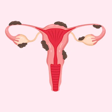 endometriosis treatment in india