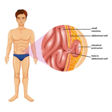 hernia surgery in india