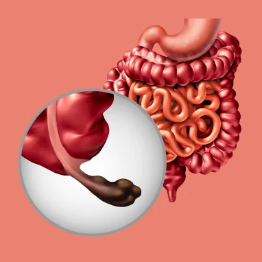 Typhoid