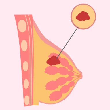 lumpectomy surgery in india