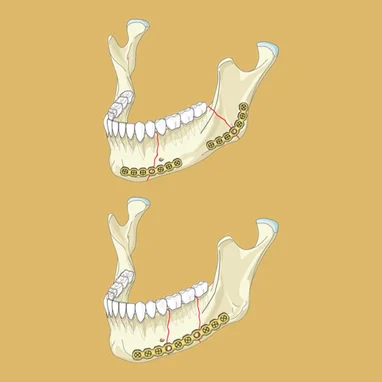 mandibular fixation surgery in india