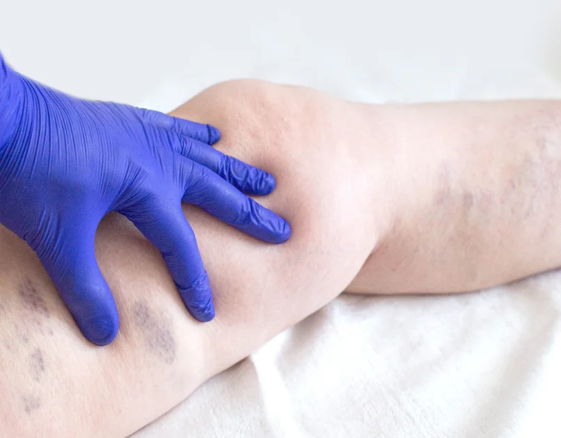 Typhoid