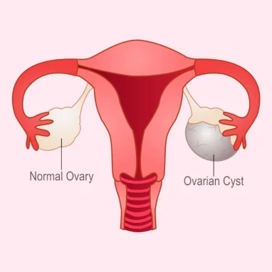 Ovarian Cystectomy Surgery in India