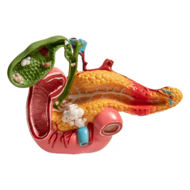 pancreatectomy surgery in india