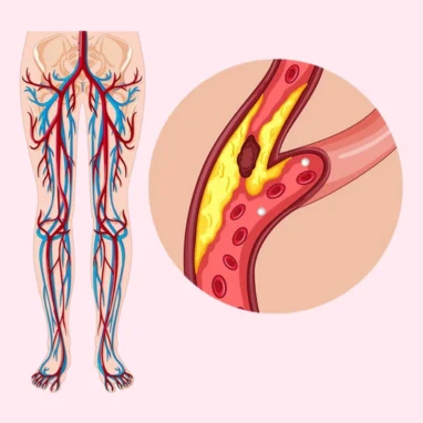 peripheral artery bypass surgery in india