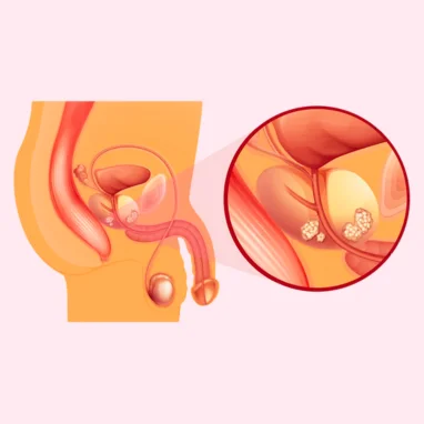 prostatectomy surgery in india