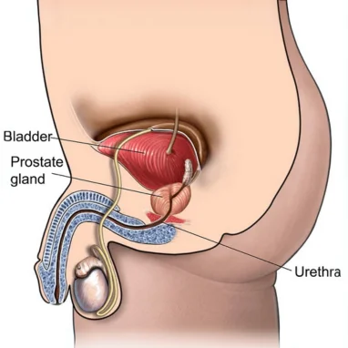 radical prostatectomy hospital in india