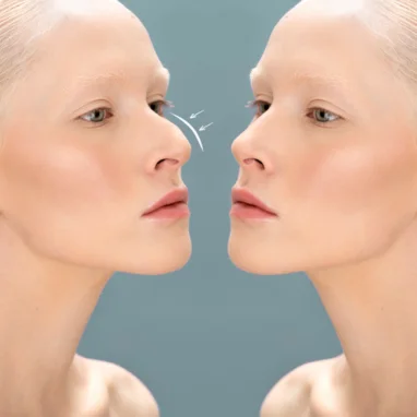 septoplasty surgery in india