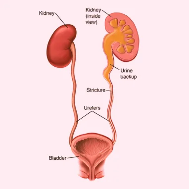ureter surgery in india