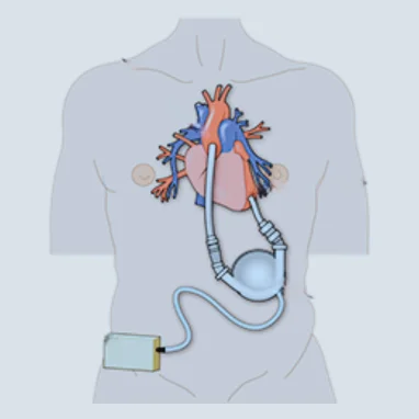 left ventricular assist device surgery