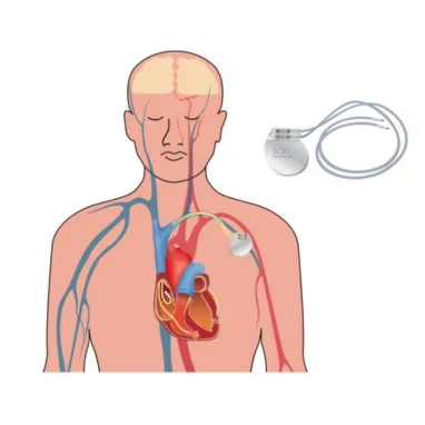 pacemaker implantation surgery in india