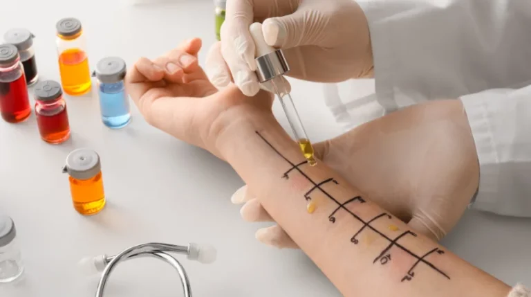 allergy skin test