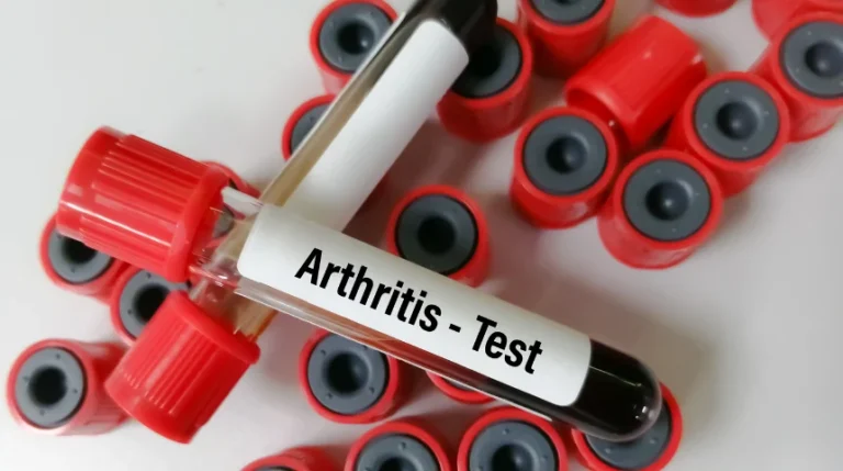 arthritis profile test