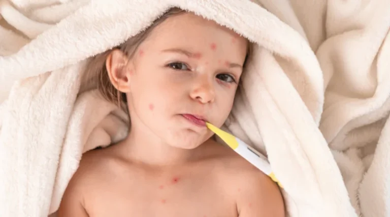 chicken pox igg