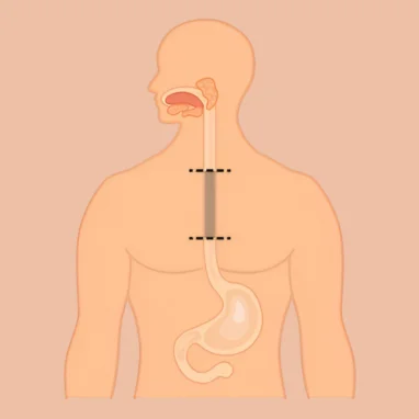 Typhoid