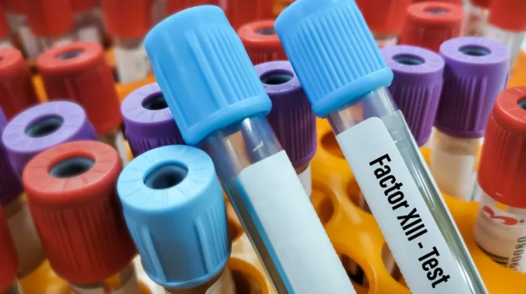 Factor XIII Test | mediSuggest
