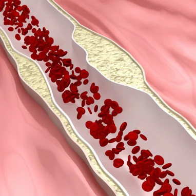 Typhoid