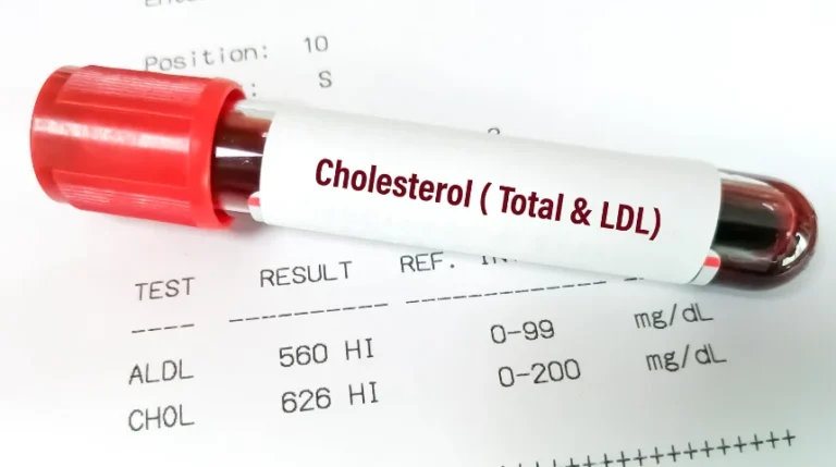 ldl cholesterol test