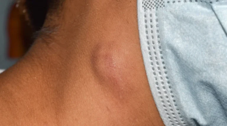 Lymph Node FNA | mediSuggest