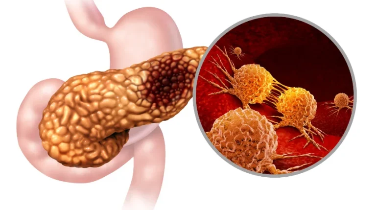 Pancreatic FNA | mediSuggest