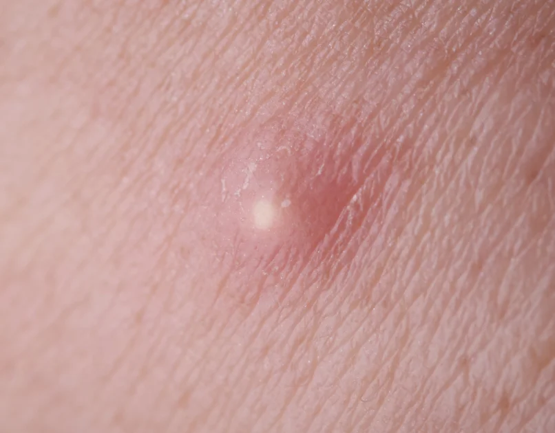 Typhoid