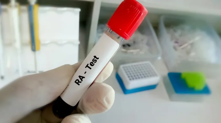 rheumatoid factor test