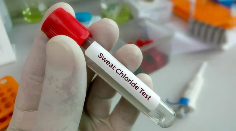 sweat chloride test
