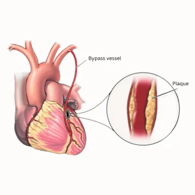 Typhoid