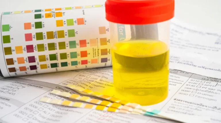 urinalysis test