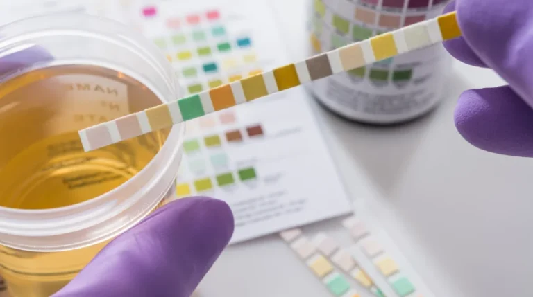 Urine Glucose Test | mediSuggest