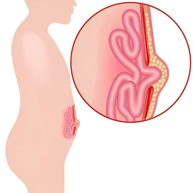 Typhoid