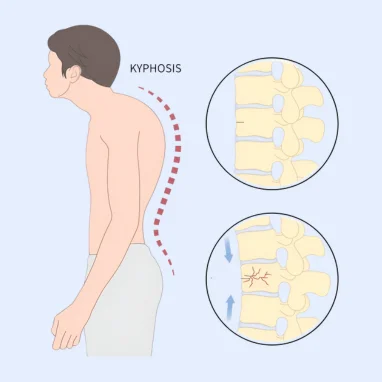 Typhoid