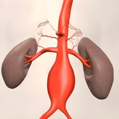 abdominal aortic aneurysm surgery in india