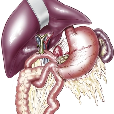 choledochojejunostomy surgery in india