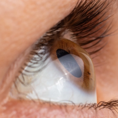 keratoconus treatment in india