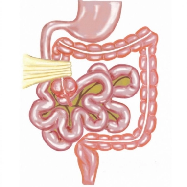 ladd's procedure surgery in india