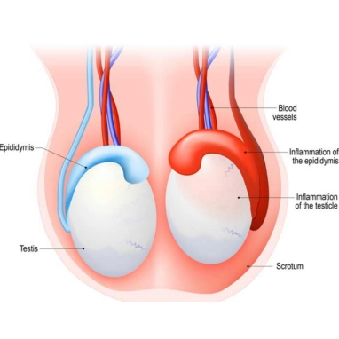orchidopexy surgery in india