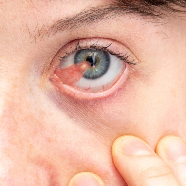 pterygium surgery in india