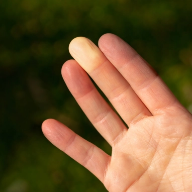 raynaud’s surgery in india