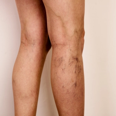spider veins treatment in india