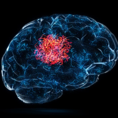 subarachnoid hemorrhage surgery in india