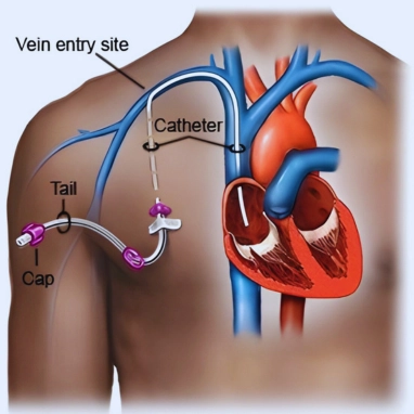 vascular access for chemotherapy in india