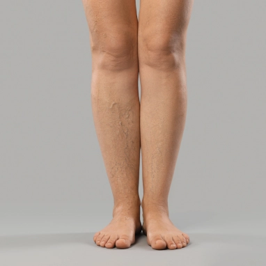 vascular malformation surgery in india